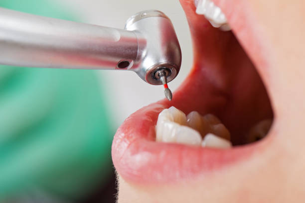 Best Emergency Tooth Extraction in Columbus, GA